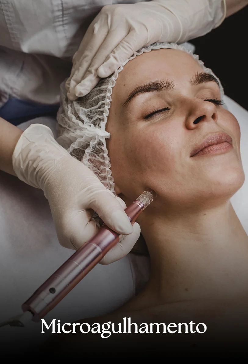 Microaculhamento em Apucarana PR